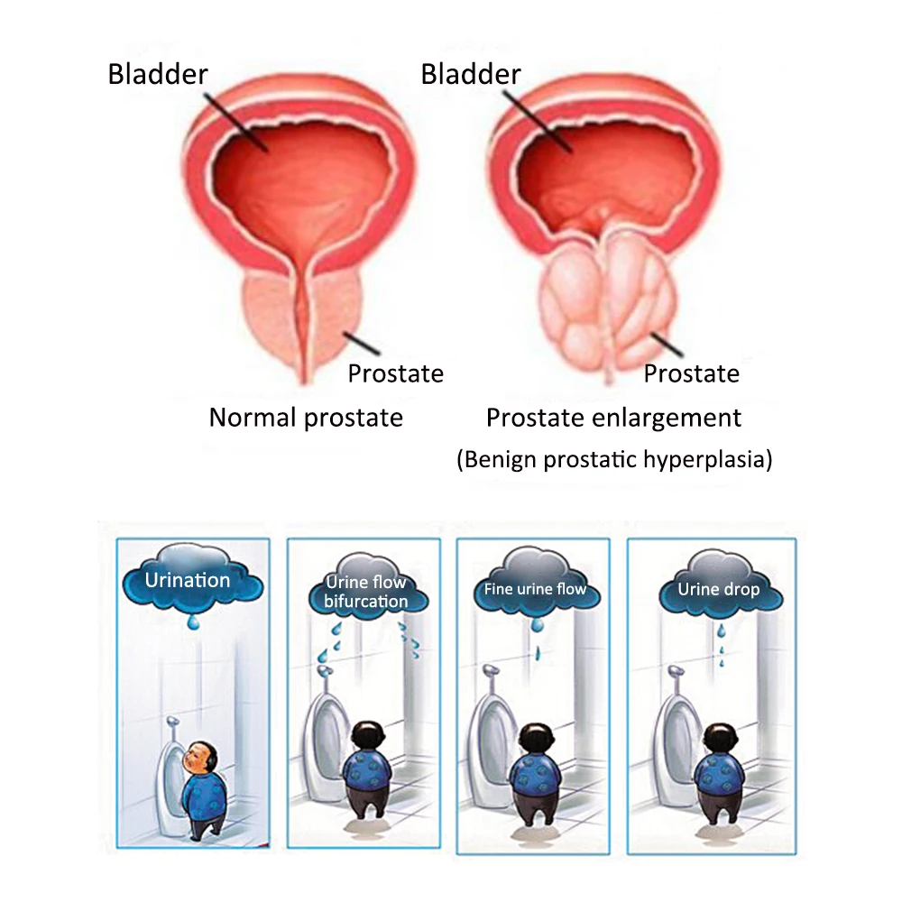 tratamentul sotului prostatita prostatita și hormonul de creștere